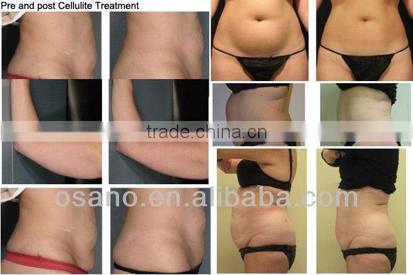 2016 new V8 multifunctional keywords cavitation rf machine