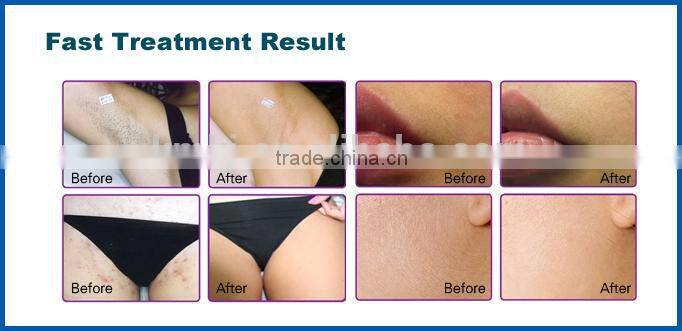 2014 new upgrade hair removal dubai with 808nm laser system (CE ROHS ISO)
