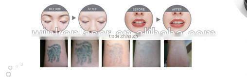 standing q-switch 1064nm 532nm long pulse nd yag laser hair removal machine