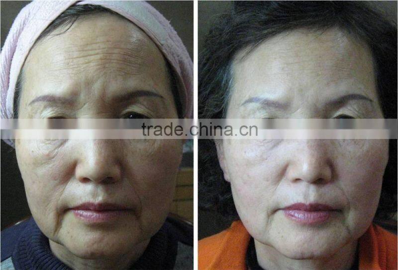 Ultrasound therapy hifu facelift wrinkle removal spa use machine