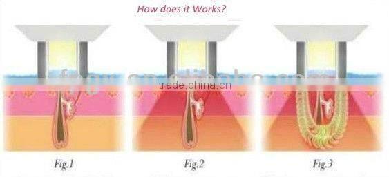 ipl blood vessel removal machine