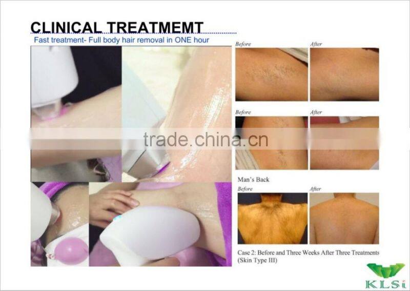 Permanent Hair Removal Laser