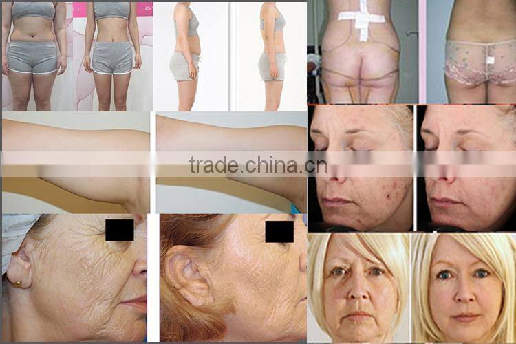 vacuum beauty machine vacuum therapy machine