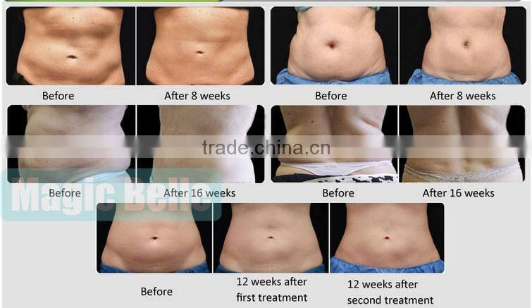 New Arrival!! Weight Loss 3 Handpiece Cryolipolysis Fat Freeze Slimming Machine for Salon Use