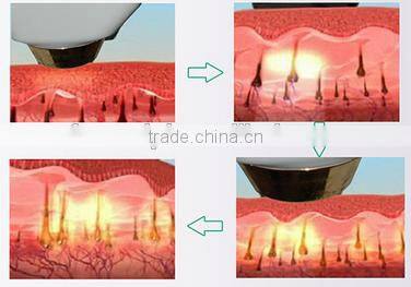 Professional Diode Laser permanent Hair Removal
