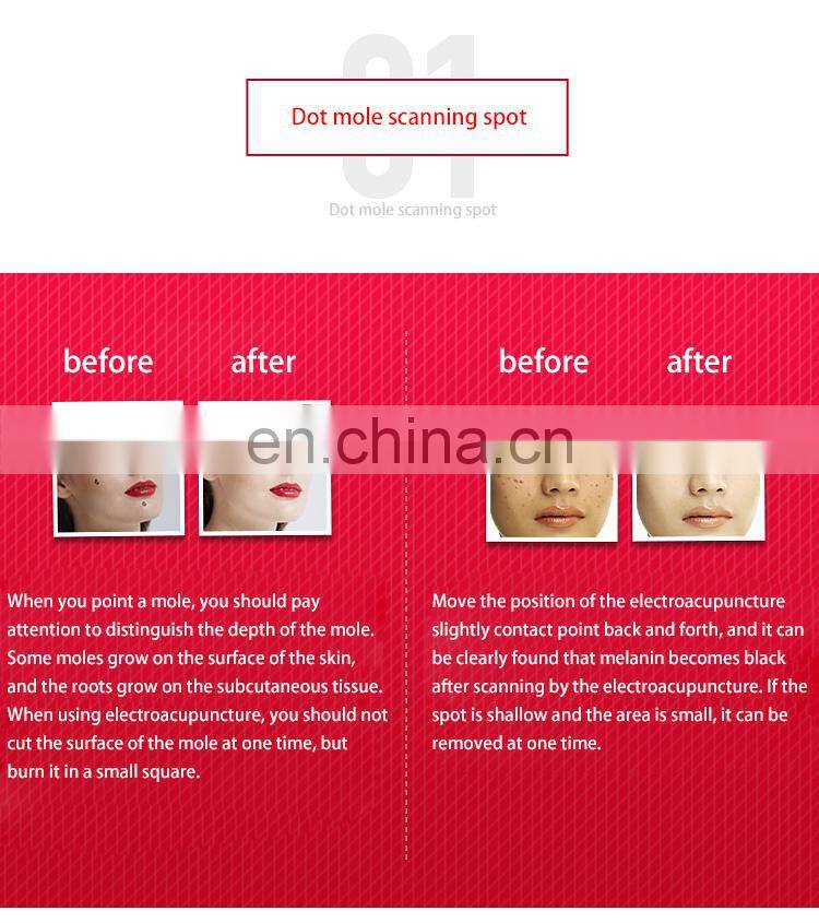 Handhold Skin Care Product Laser Mole Removal Pen Spot Removal Plasma Pen