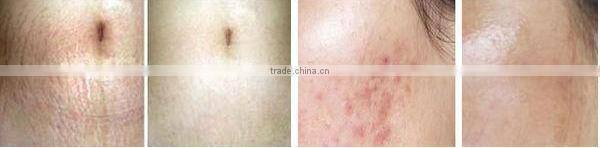 2013-2017 the most professional +powerful 540 deep-tissue massage roller