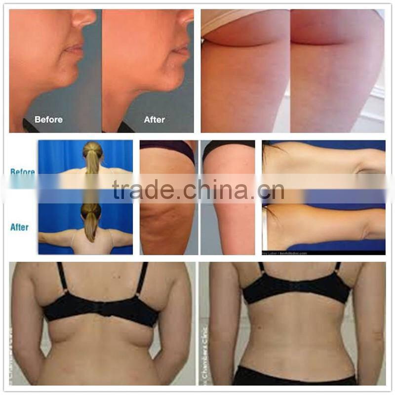 lipo freeze treatment coolsculption areas/ non surgical belly fat removal