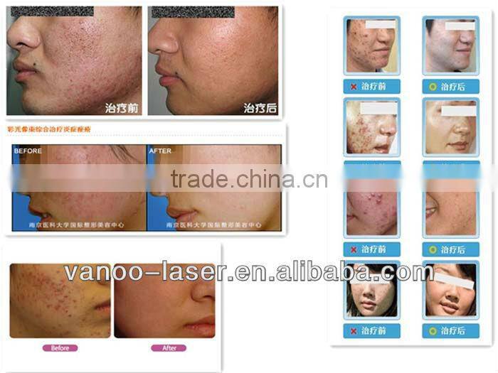 Best acne treatment / acne treatment skin care pdt machine