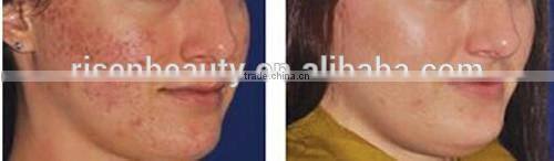 Professional 180/600/1200 Needles Derma Roller/ 3 in 1 Derma Roller Kit/ Medical Grade Derma Roller