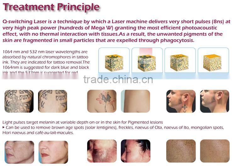 Good effects closed-off water circulation + air cooling system nd yag laser for tattoo removal