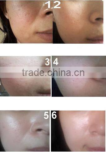 540 needles Microneedle derma roller Improve skin and delicate L005