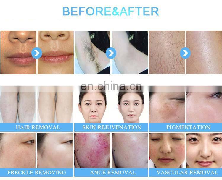 portable 2 in 1 opt nd yag lasere with 2 handles for hair/tattoo removal