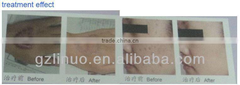 2013-2017 popular new technology RF laser vacuum laser skin treatment machine (The newwest technology !!!!!!!!!)