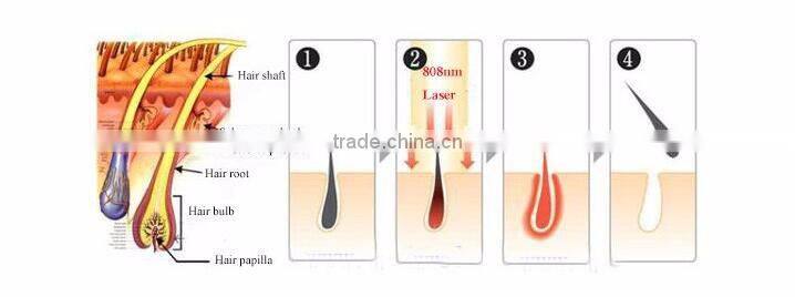 Hot Sale Large Spot Size Laser 808 Hair Removal Laser Epilation Home