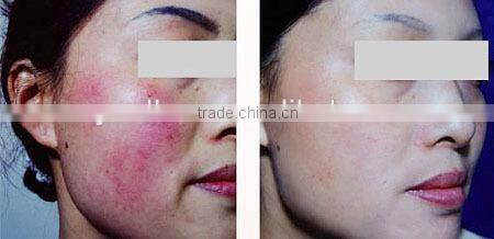 2015 Trading Products for Import 30.56MHz High Frequency RBS Spider Vein Removal Machine