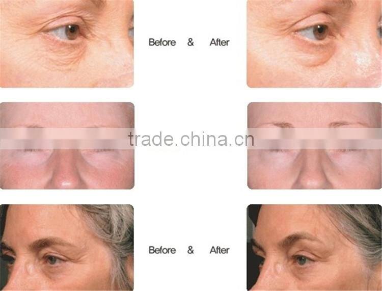 Home use bipolar RF facial wrinkle removal around mouth beauty equipment