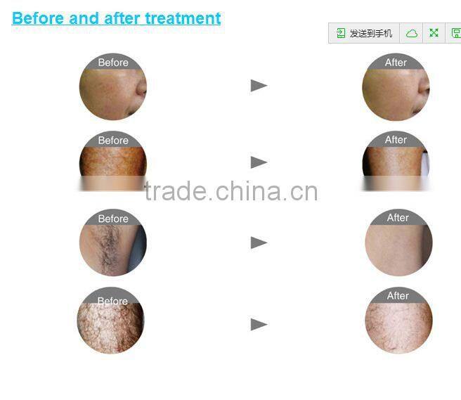 Sanhe Professional 808nm diode laser hair removal machine