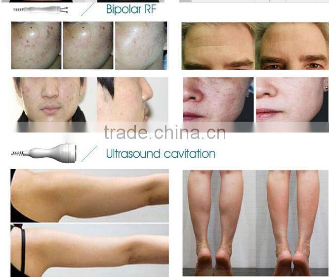 2016 portable HIFU shaping and face lifting machine/ limming beauty machine RF + vacuum slimming weight loss