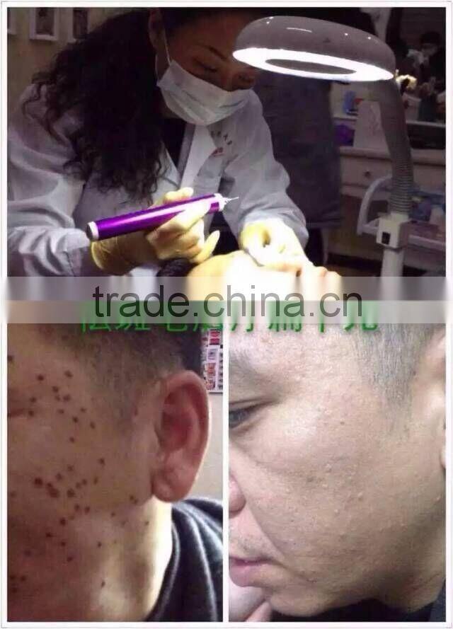 High Frequency Spot Removal Pen speckle removal