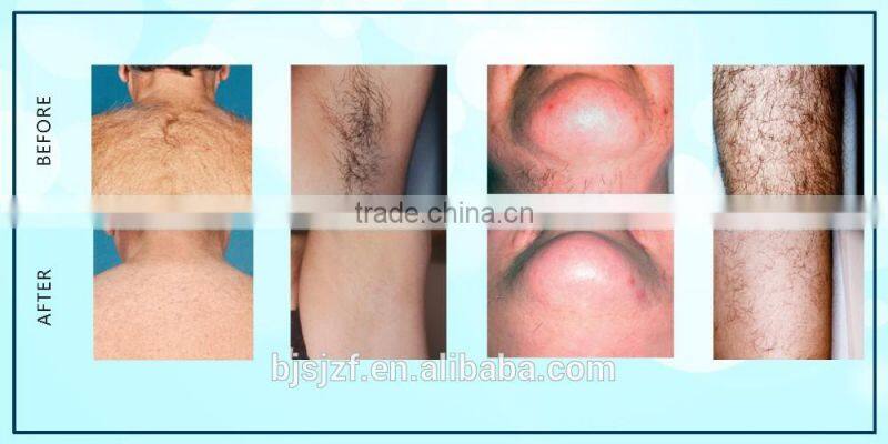 2016 awesome 808nm Diode Laser machine 808t-2 for Hair Removal