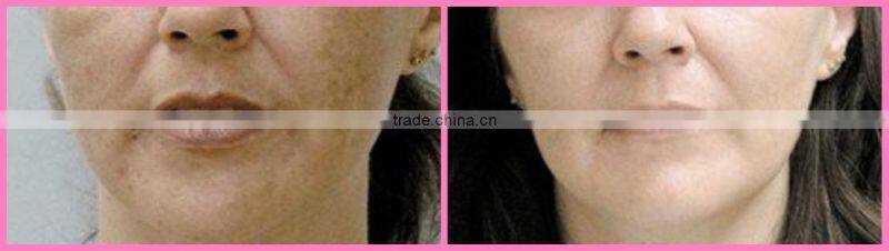 E-light Laser Hair Removal Machine for Sale