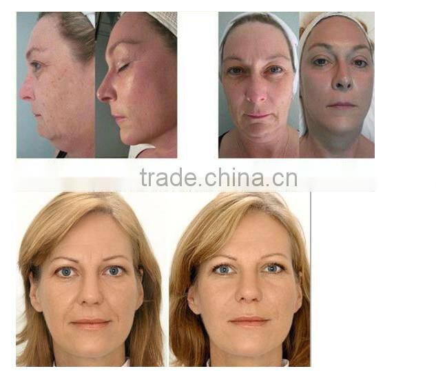 2014 Home Use meso gun meso pen meso roller no needle mesotherapy