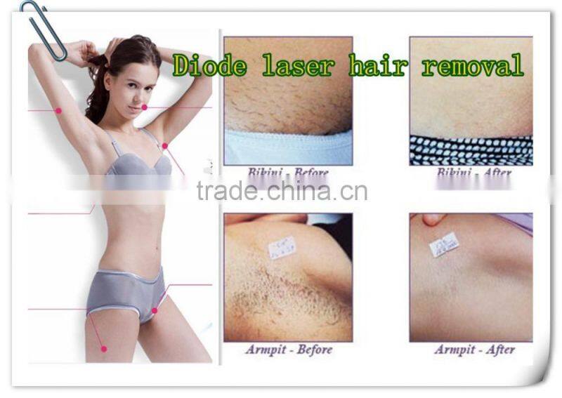 Professional Cosmetic Elight Skin Rejuvenation plus 808nm Diode Laser beauty equipment