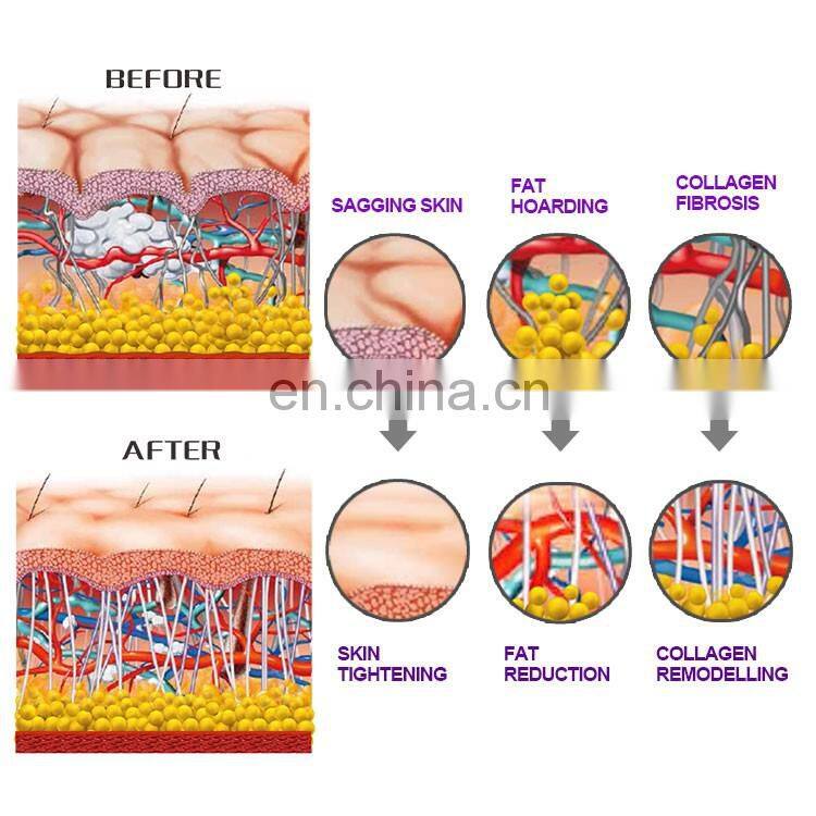 VELASHOCK combines RF velashape with shock wave therapy Vacuum Roller beauty equipment