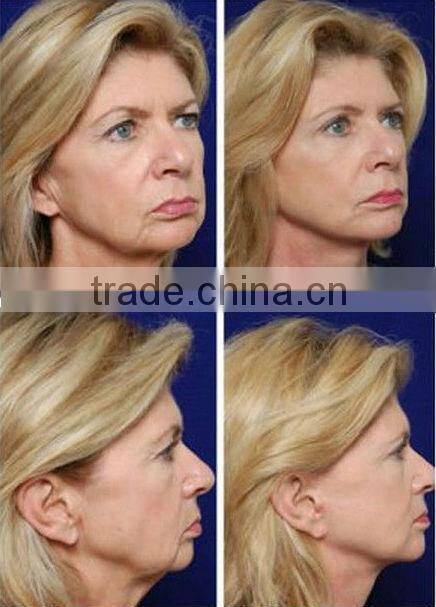 Advanced cooling system painless permanent laser shr IPL hair removal machine