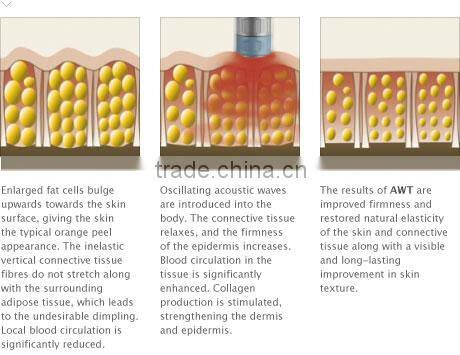 2016 Best Fast Pain Relief Cellulite Removal Shock Wave Acoustic Wave Machine