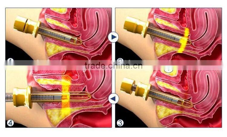 Non-invasive vagin tightening equipment