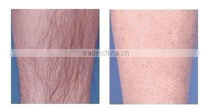 755nm Alexandrite laser machine with optimal & supper handle to remove hair painless