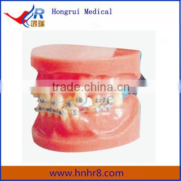 Medical teeth Fixed Orthodontic Model (Dislocation)