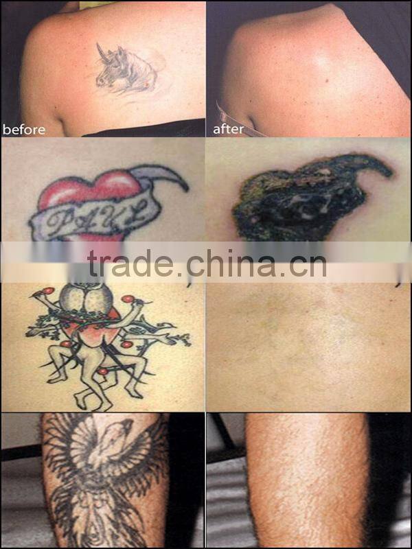 Easy work professional 1064nm 532nm Portable Q Switched Nd yag laser ipl tattoo removal machine