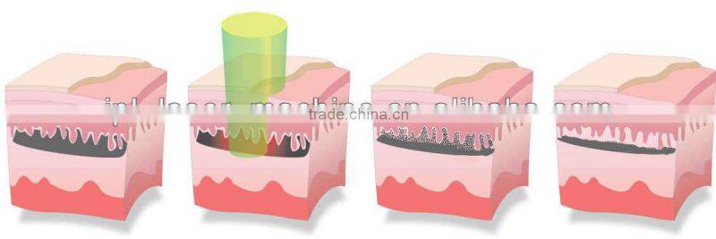 tattoo removal laser / ng yag laser / laser nd yag 1064 hair removal