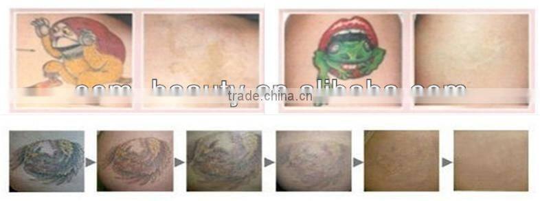ce approved nd yag laser tattoo removal painless salon used machine with lowest price