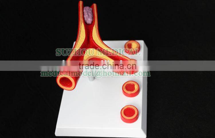 Atherosclearosis and thrombosis model