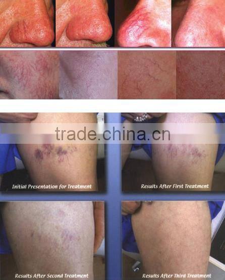 spider vein removal machine