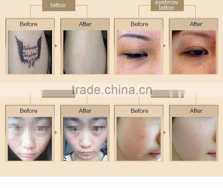2016 Melasma Age spots tattoo removal cream laser tattoo removal machine price