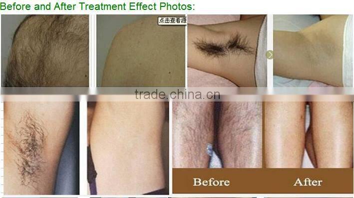 2016 best selling beauty spa wanted supplier portable 808nm diode laser permanent hair removal machine price