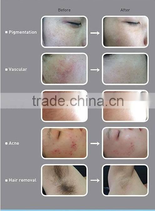Hot selling!! AFT shr ipl acne treatment equipment/ipl-hair-removal.de
