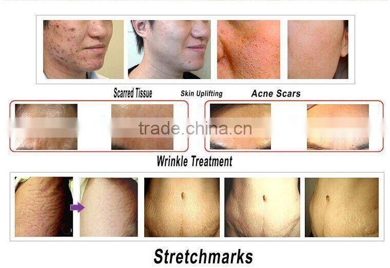 CE approval dermaroller 180 titanium microneedle derma skin roller