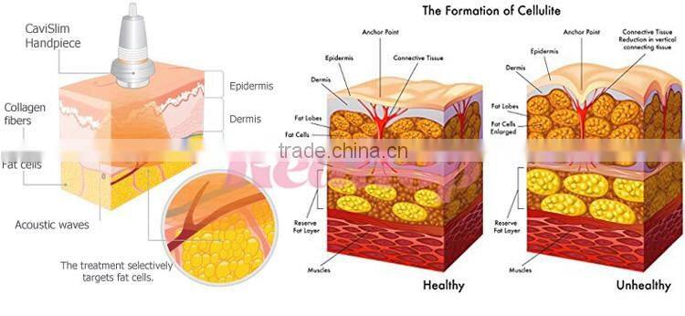 keyword ultrasonic cavitation radio frequency machine explosive speed grease cavitation beauty machine