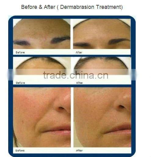 GD-11Professional diamond peeling mircodermabrasion beauty machine