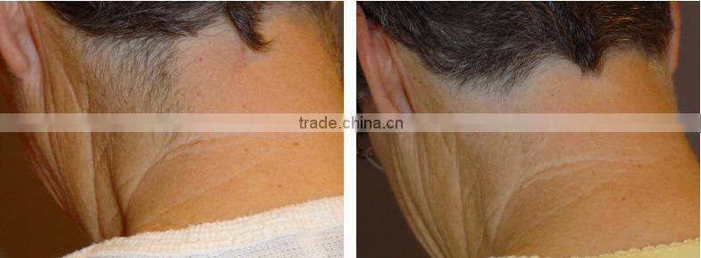 810NM DIODES LASER HAIR REMOVAL machine