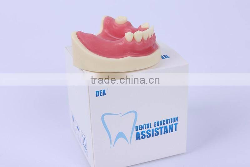 New Type Good Quality Dental Implant Model with teeth