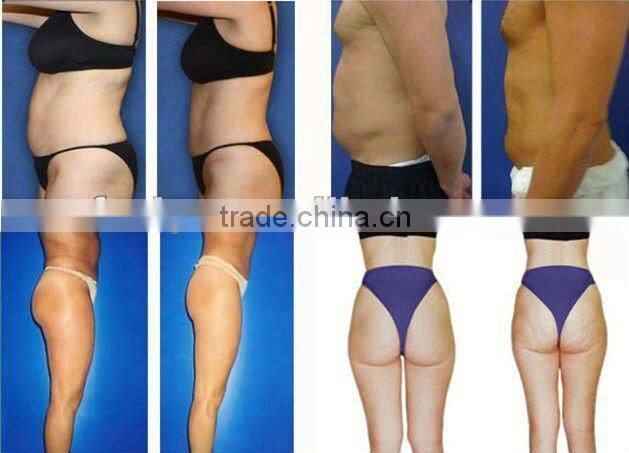 VY-Q2A Hot sale internal ultrasonic liposuction slimming equipment (with ce)