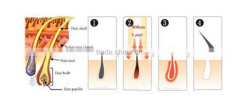 Best price salon use 808 laser used for hair removal