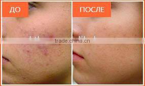 MBT LASER shr ipl Professional Multifunction digital permanent hair removal skin rejuvenation opt machine